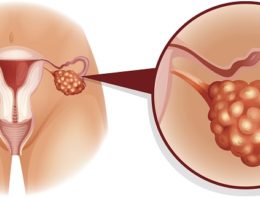Le cancer des ovaires : causes, symptômes et traitements